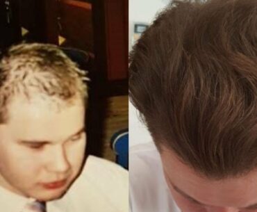 Finding Right Dermaroller | Vitamin Deficiency | Hair Regrowth