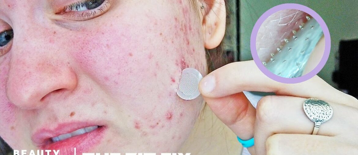 Microneedle Patch Works To Erase Acne Scars And Dark Spots | The Zit Fix