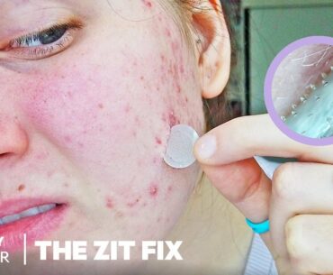 Microneedle Patch Works To Erase Acne Scars And Dark Spots | The Zit Fix