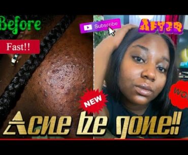 Black girl gets rid of acne fast (Korean Skincare)