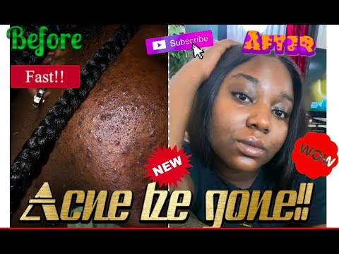 Black girl gets rid of acne fast (Korean Skincare)