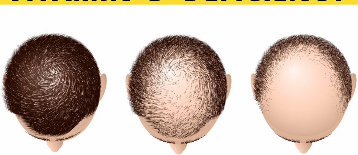 SYMPTOMS OF VITAMIN D DEFICIENCY | DEPRESSION | HAIR LOSS |  SILVA GUIDE |