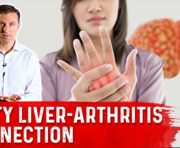 Why Does a Fatty Liver Triggers Arthritis?