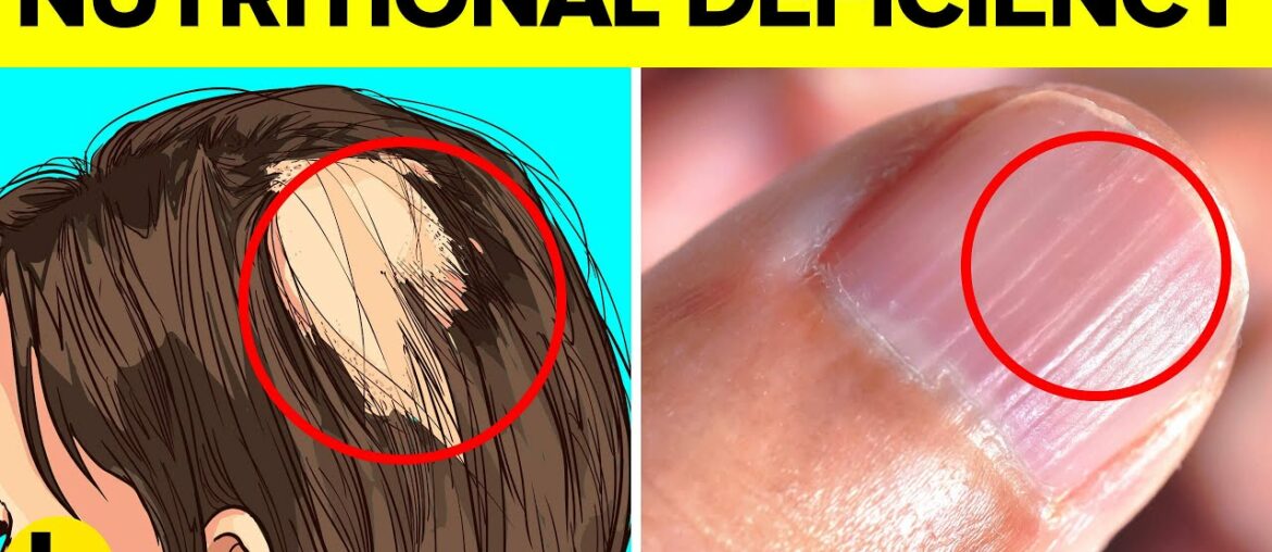 14 Signs That Indicate You Have A Nutritional Deficiency