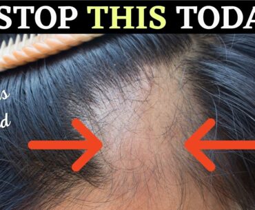 ONE VITAMIN FOR HEALTHY HAIR | Dr. Raj