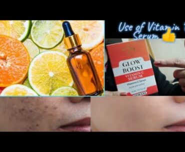 Get Rid of Hyperpigmentation, Melasma || Vitamin "C" Serum 100% Results