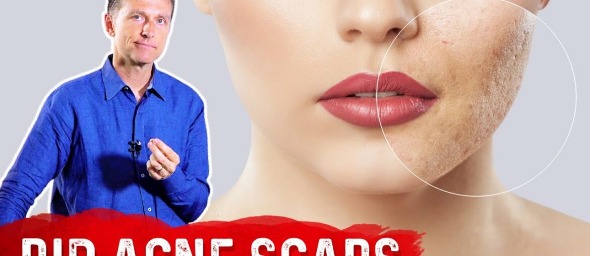 Best Way to Rid Acne Scars