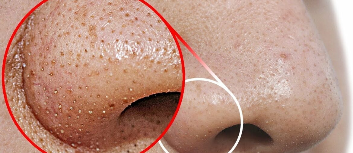 I Apply Vitamin C Lemon on my nose  & it Removed Dark spots & Wrinkles - GLASS Skin Serum