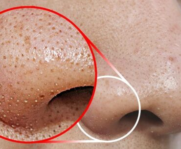 I Apply Vitamin C Lemon on my nose  & it Removed Dark spots & Wrinkles - GLASS Skin Serum