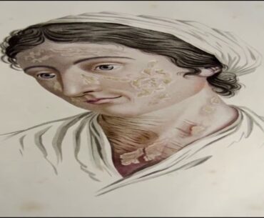 Deficiency Diseases, Nutritional Diseases, Vitamins And Deficiency Diseases, Nutritional Deficiency