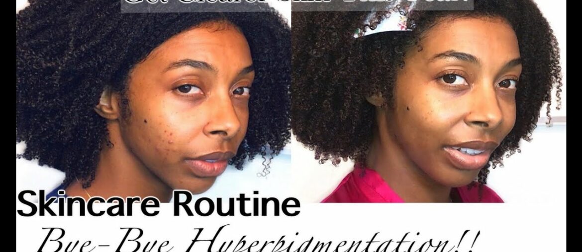 Skincare Routine w/ Ambi To Reduce Dark Marks & Inflammation | Post Inflammatory Hyperpigmentation