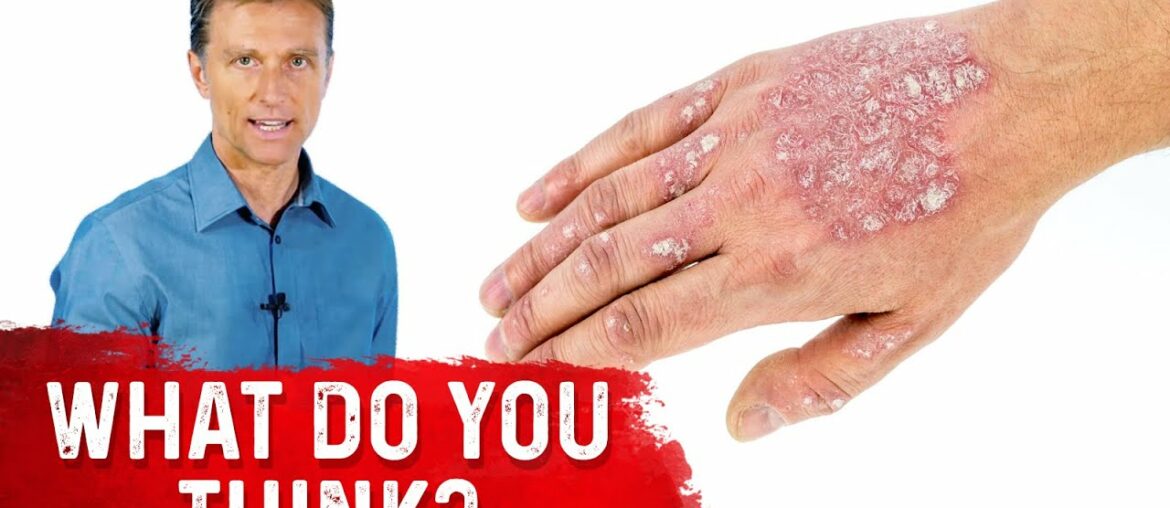 Is Psoriasis Contagious?
