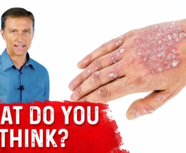 Is Psoriasis Contagious?