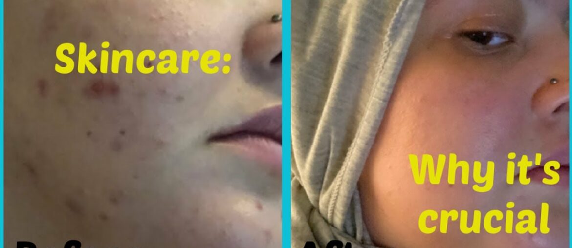 Why proper skin care matters | Health and Fitness | How I cleared up my skin | Affordable products