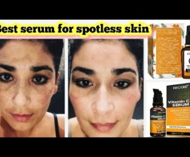 Best vitamin c serum for face | Pigmentation | melasma | Acne scars | Fair skin | Brijwasi Girl