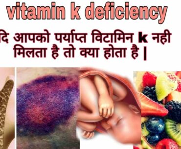Vitamin-k deficiency|causes|symptoms and diet in hindi | Medical destination |