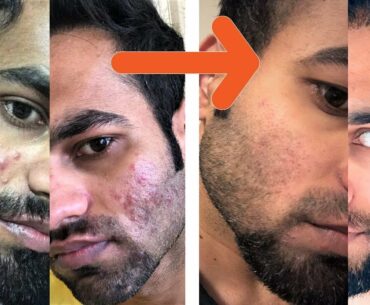 My acne Journey! Antibiotic, Accutane, probiotics, vegan diet, Vitamin B5# it can be cured.