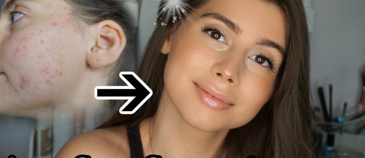 ACNE SCAR COVERAGE BOMBSHELL NATURAL MAKEUP LOOK!! || Look Your Best With Acne Scars!