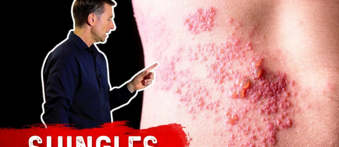 Shingles: Natural Relief