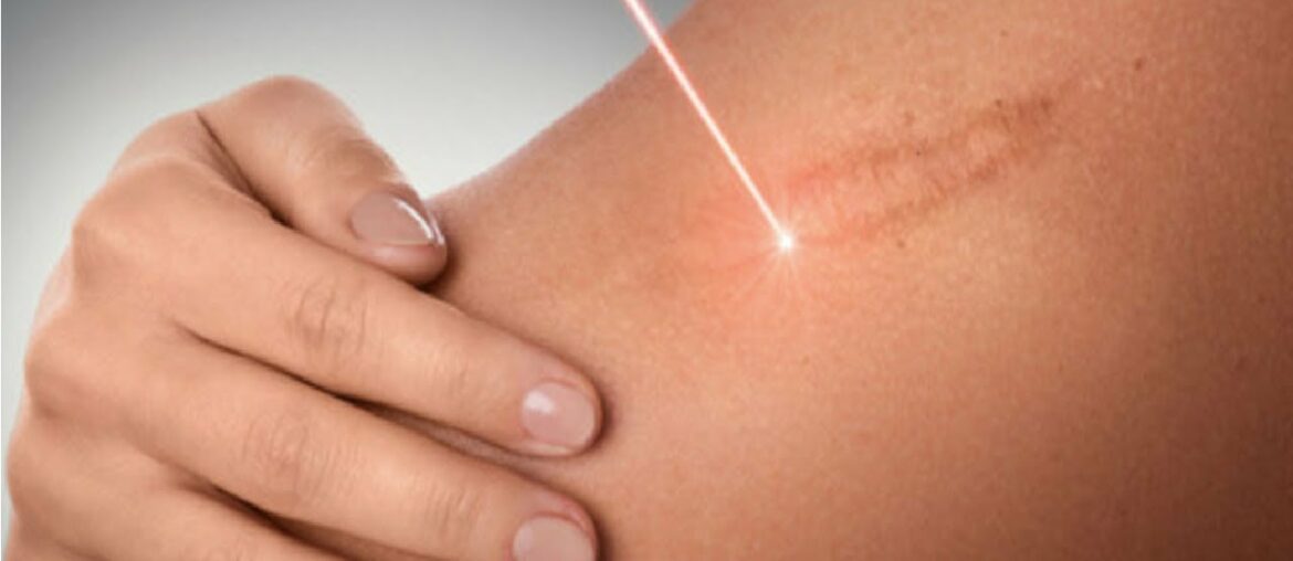 how to get rid of burn scars from boiling water