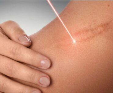 how to get rid of burn scars from boiling water