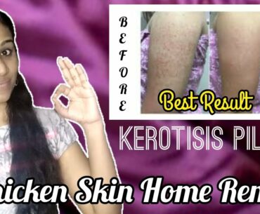 Kerotisis Pilaris | Chicken Skin | Home Remedy | Vitamin A deficiency | Skin Care |Tamil Beauty Tips