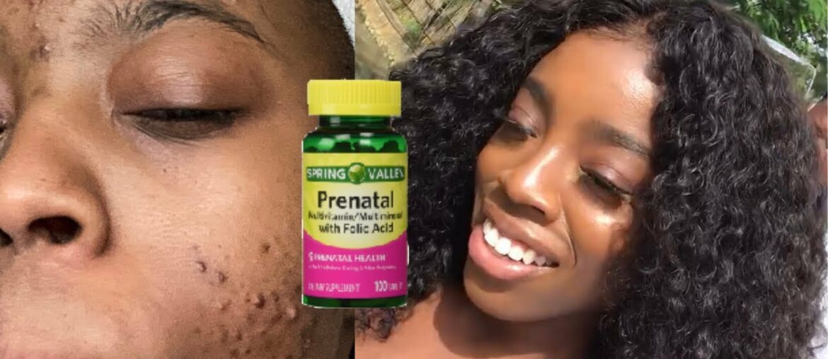 Spring Valley Prenatal Vitamins | My secret to Clear Skin?!!! Healing my Acne Fast
