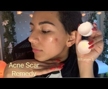 Acne scar hack / tip | Natural Vitamin E