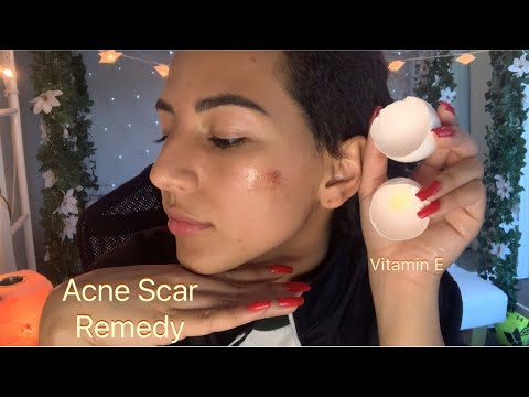 Acne scar hack / tip | Natural Vitamin E