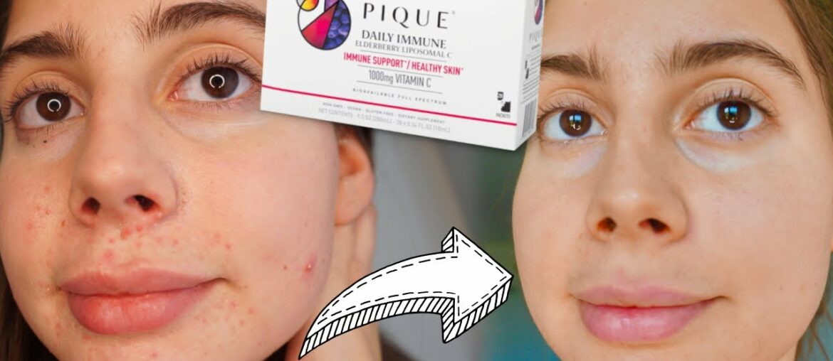 I TESTED 2 WEEKS OF VITAMIN C SUPPLEMENTS FOR CLEAR SKIN || Does Pique Tea Work!?!?