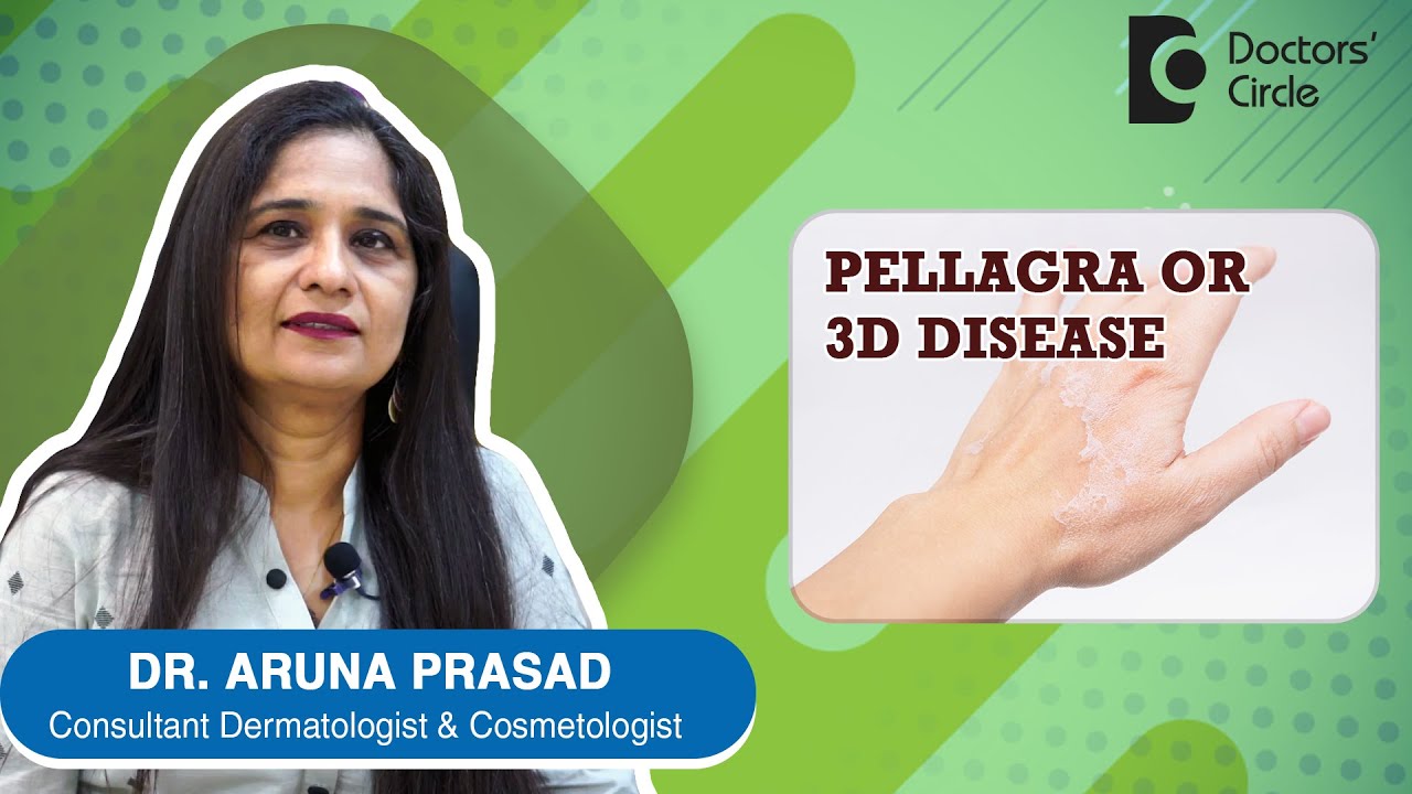 Vitamin B3 Deficiency Why is pellagra called as 3D disease? Dr. Aruna Prasad Doctors