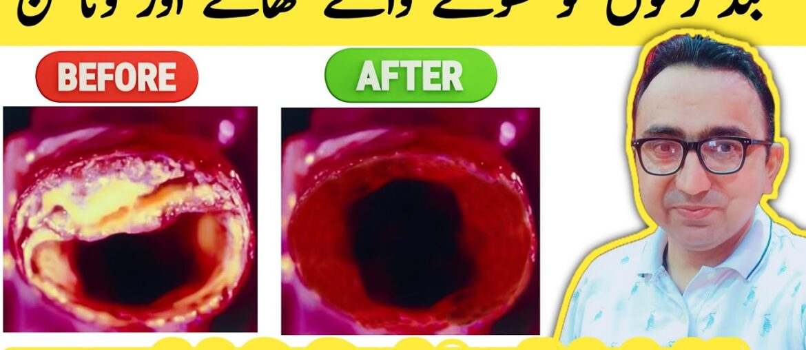Best Foods & Vitamins To Clear Out Your Arteries