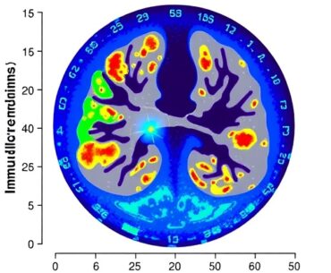 Immune Microenvironment Score Predicts NSCLC Treatment Success