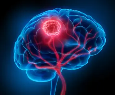 Simple supplement mix shows remarkable results in brain cancer