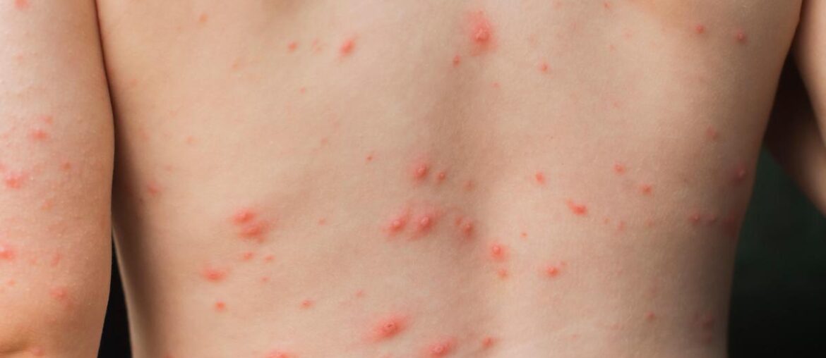 Chickenpox vaccine could eradicate the virus in the UK in a decade