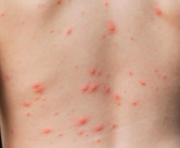 Chickenpox vaccine could eradicate the virus in the UK in a decade