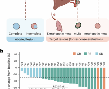 Cryoablation induces abscopal immunity in intrahepatic cholangiocarcinoma