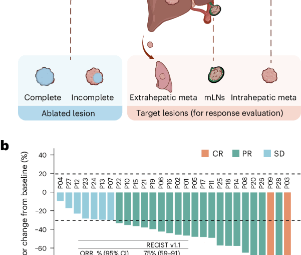 Cryoablation induces abscopal immunity in intrahepatic cholangiocarcinoma