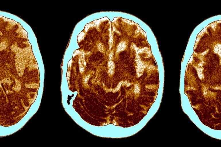 The curious link between Alzheimer’s disease and cancer