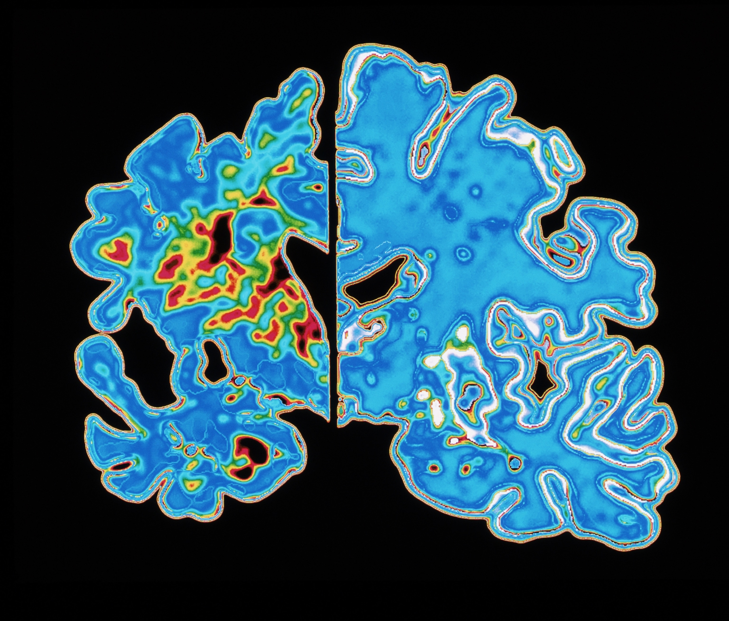 False-color image of a brain scan, split in half. The left side is visibly smaller, with areas of red and yellow indicating the presence of disease; the right side is larger and mostly blue.