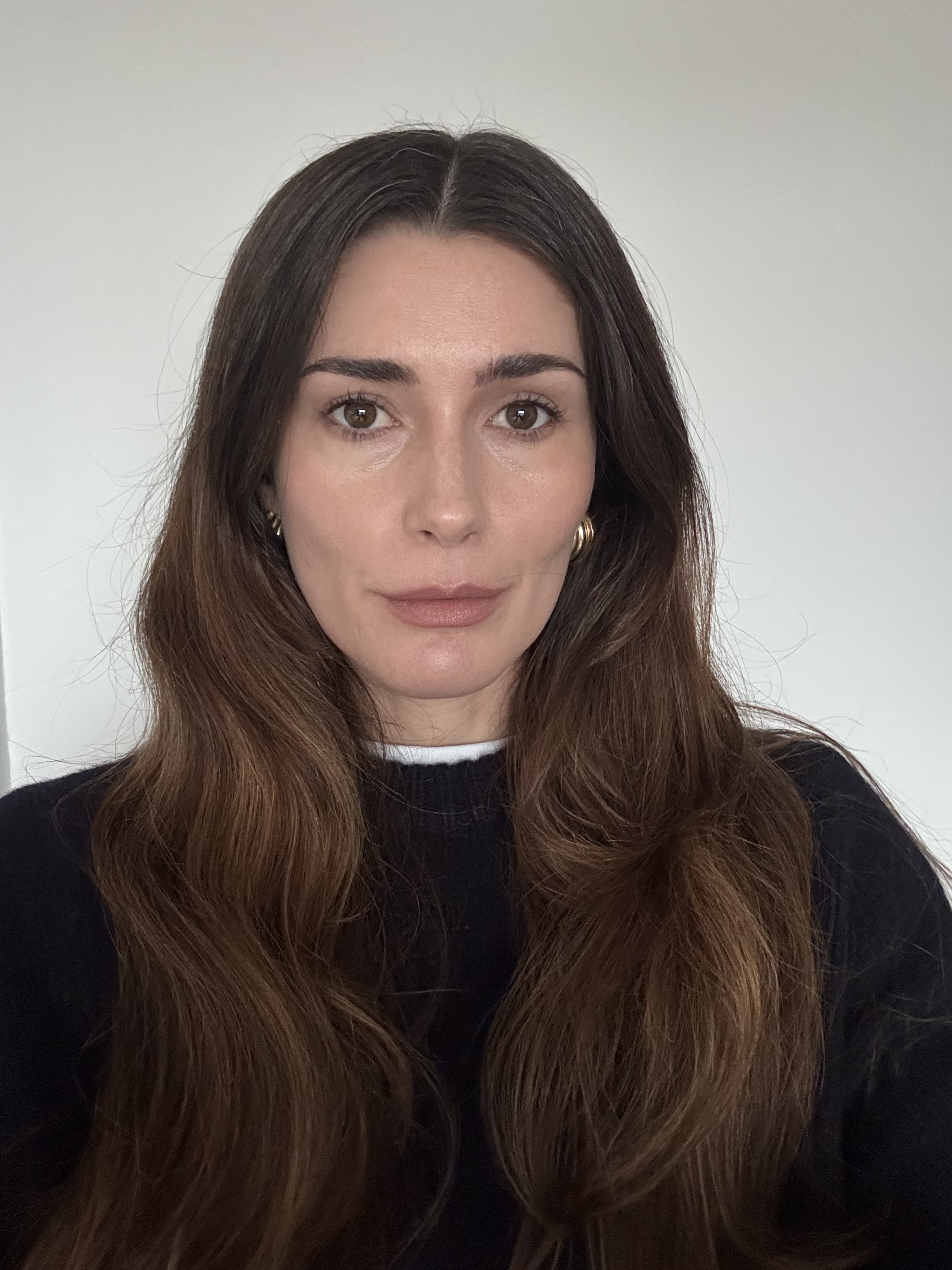 Eleanor two months after having masseter Botox