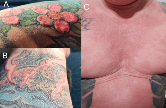 Panel of three, close-up images showing red, raised skin reactions in red pigmented skin of a forearm tattoo and across the man's chest.