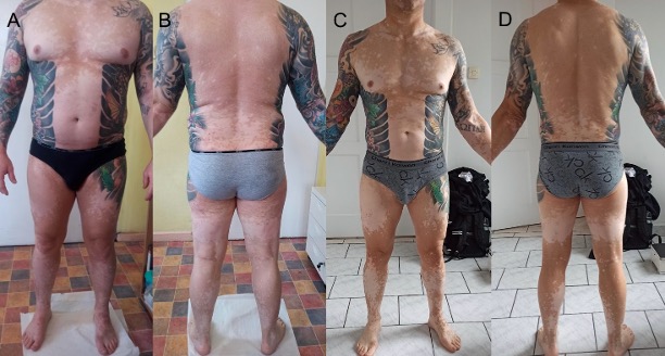 Panel of images of man from chest down, wearing underwear, to show patches of lightened skin across his body.