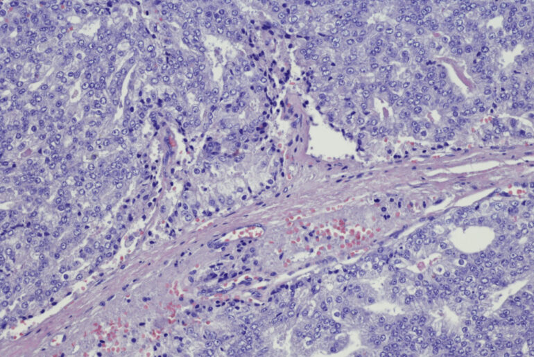 Autovaccine Reawakens Immune System in ‘Cold’ Prostate Cancer