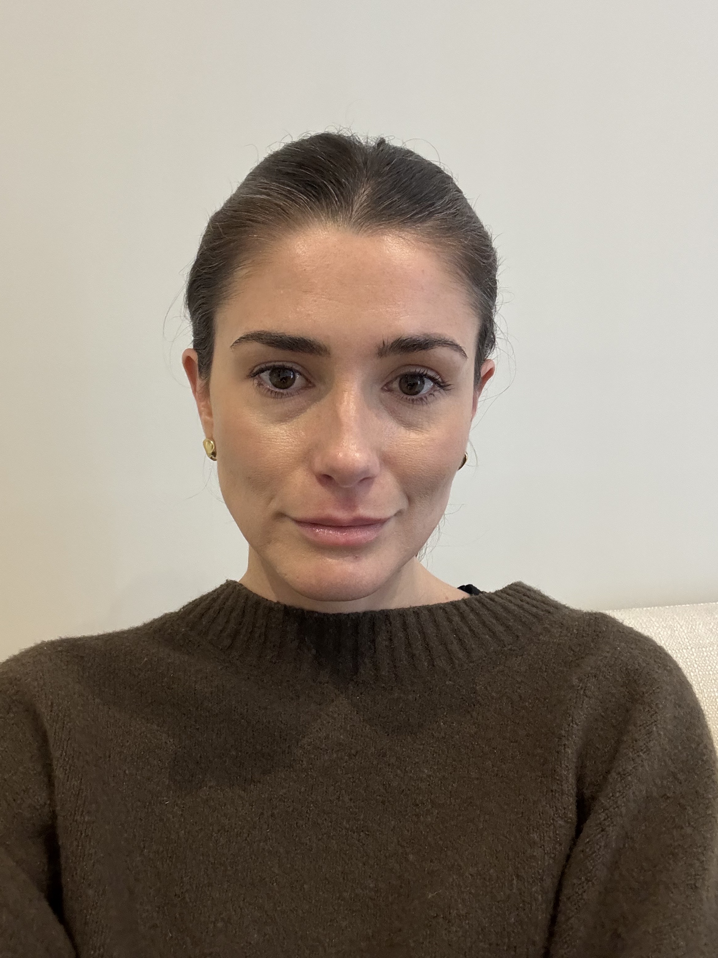 Eleanor before having masseter Botox