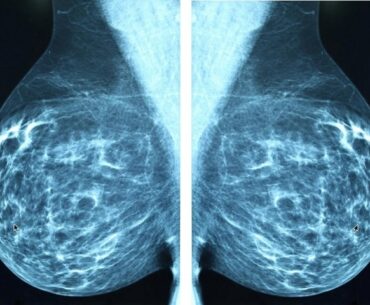 Study uncovers how aggressive breast cancer cells escape immune defenses