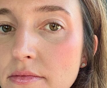 Results for Post-Acne Skin: The Matrix Treatment Review