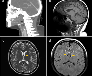 Thiamine Deficiency After Bariatric Surgery: Early Neurological Complications and Nutritional Monitoring