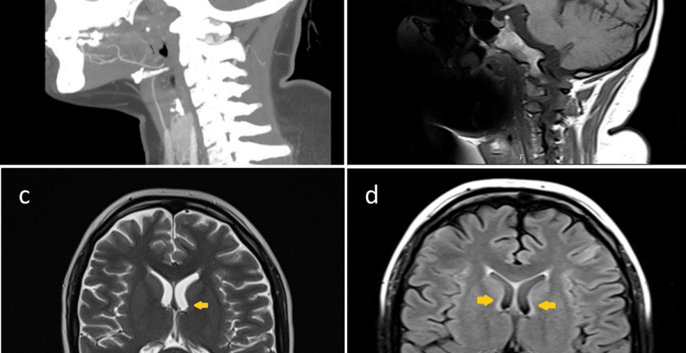Thiamine Deficiency After Bariatric Surgery: Early Neurological Complications and Nutritional Monitoring
