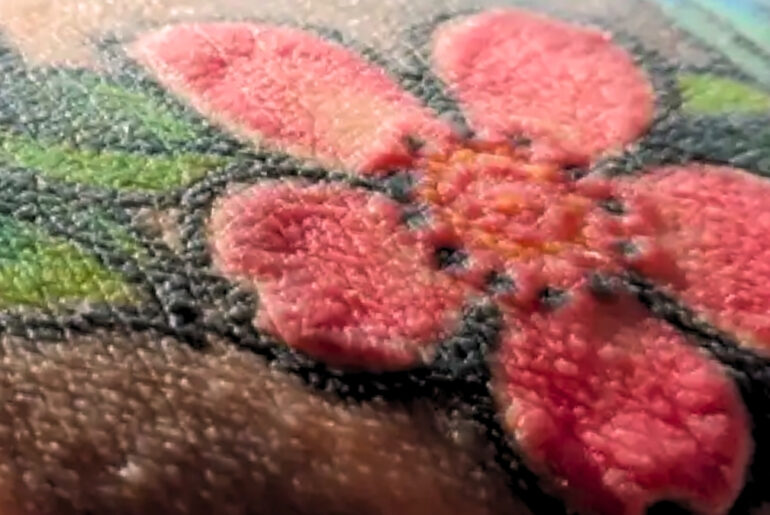 Red Tattoos Triggered Shocking Immune Reactions in Polish Man : ScienceAlert